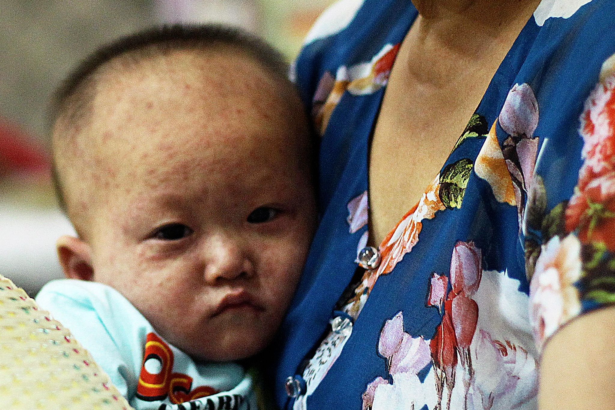 as-measles-hits-43-provinces-in-vietnam-officials-warn-of-potential